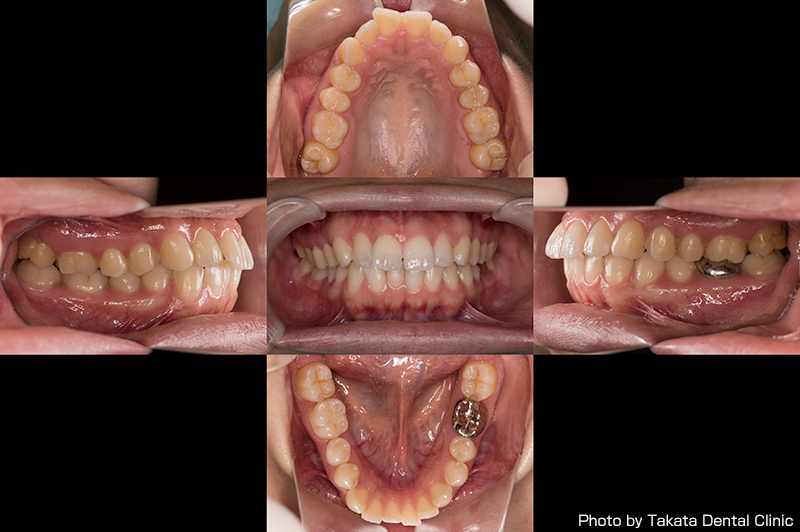 LDB for Yongnuo :: Organic Dentistry